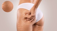 Orange peel affect of cellulite - Dr. Michele Green Helps Separate The Truths From Myths About Cellulite