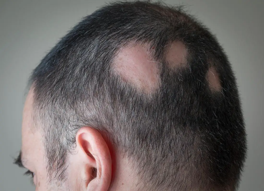 partial-alopecia